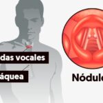 Nódulos en las Cuerdas Vocales – Cómo Evitarlos