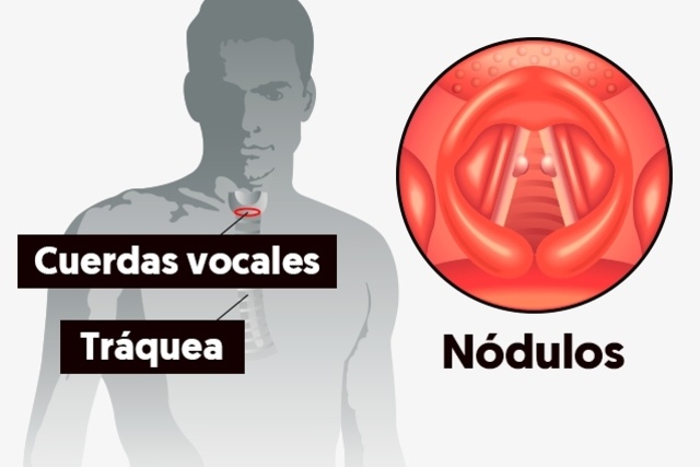 nodulos en las cuerdas vocales
